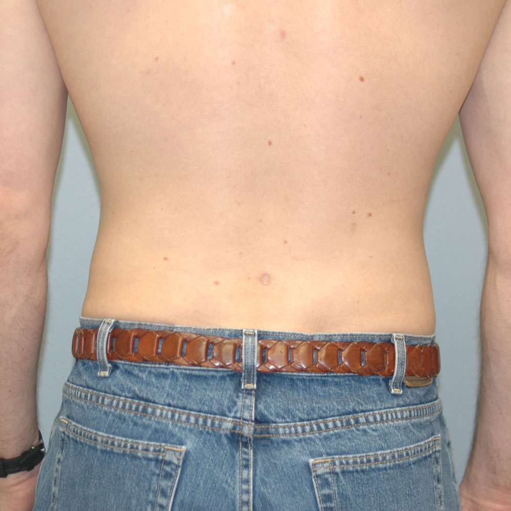 Case 1010 Back View, After Male Liposuction in Lake Oswego & Portland, OR