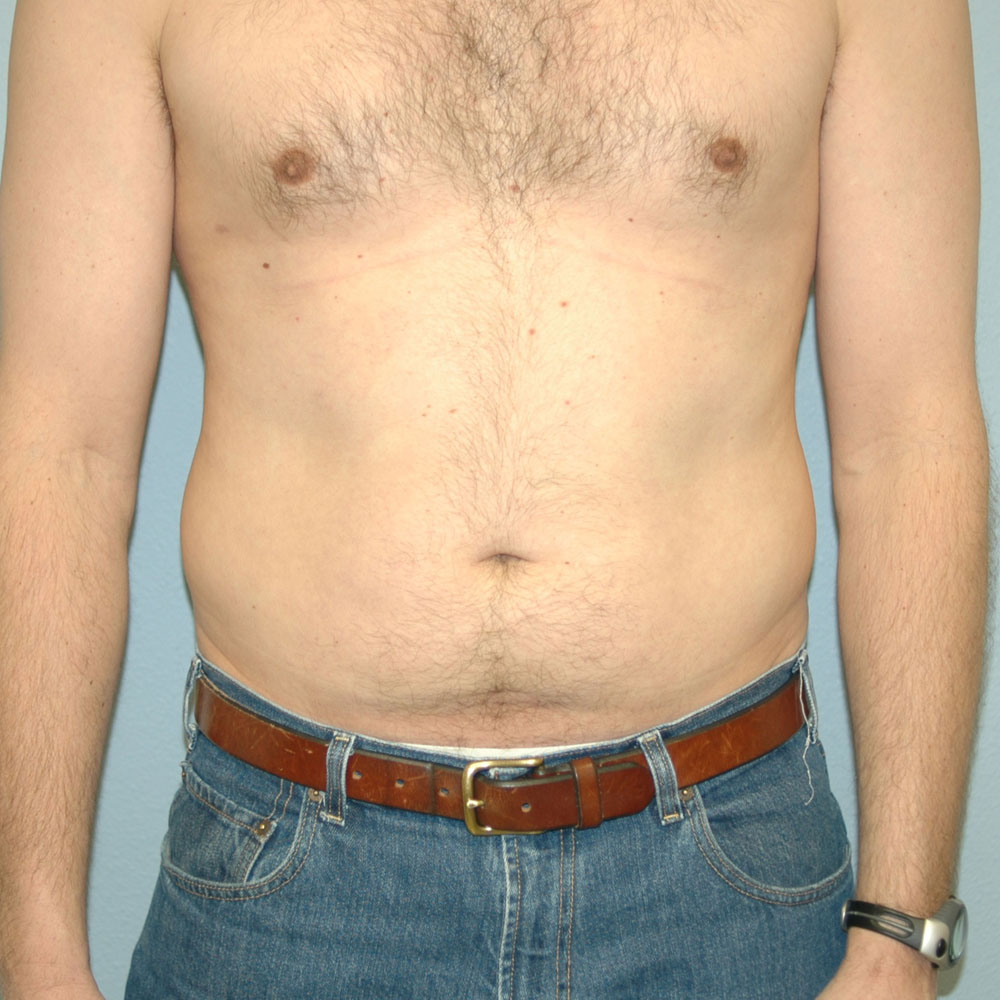 Case 1010 Front View, Before Male Liposuction in Lake Oswego & Portland, OR