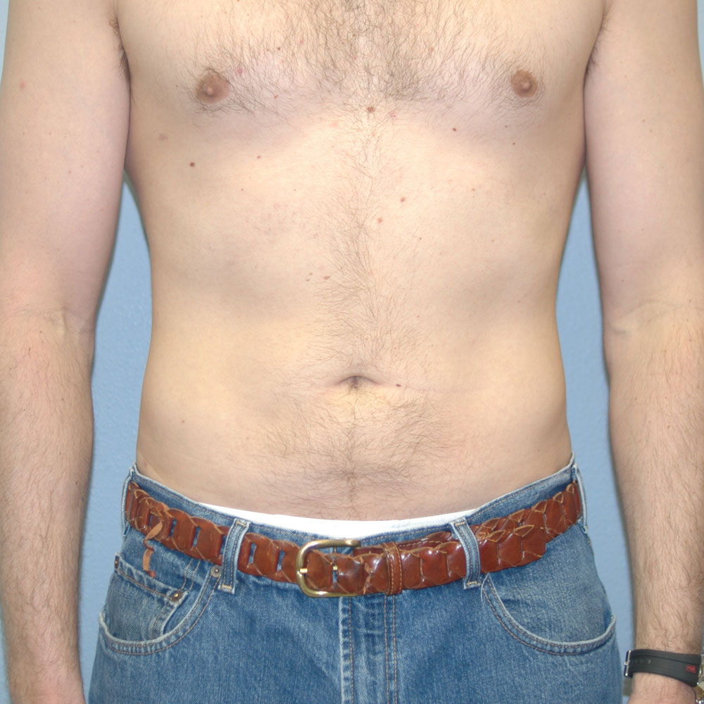 Case 1010 Front View, After Male Liposuction in Lake Oswego & Portland, OR