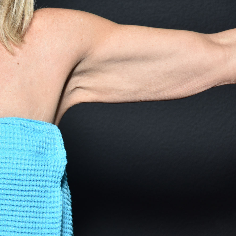 Case--2120 | After Microneedling