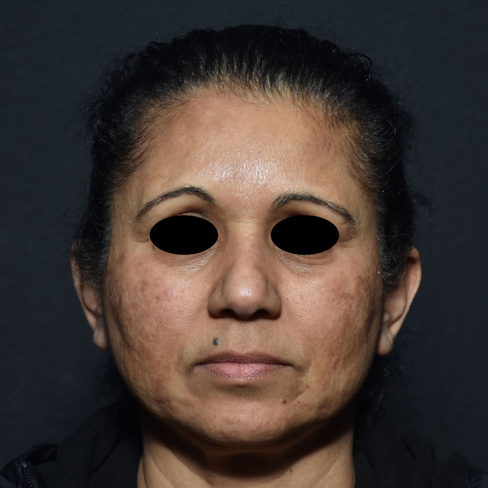 Case--2127 | Before Microneedling (Face)