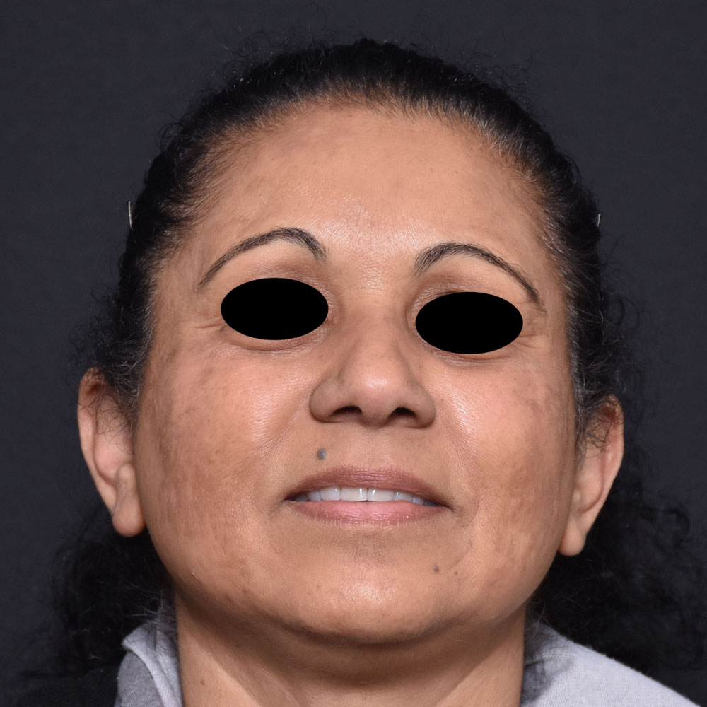 Case--2127 | After Microneedling (Face)