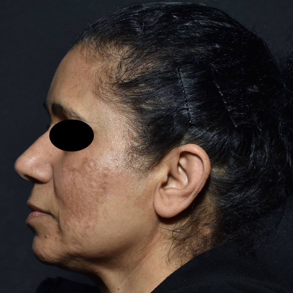 Case--2127 | Before Facials and Peels 2