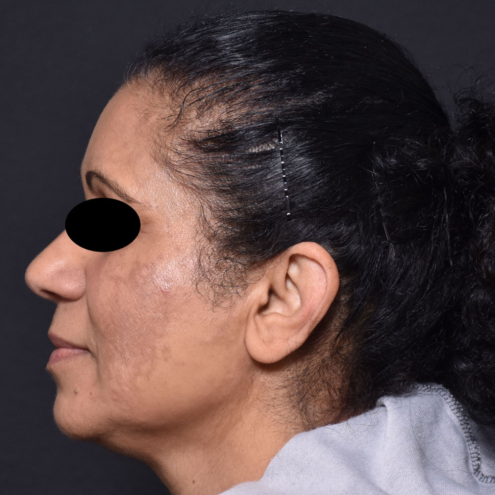 Case--2127 | After Facials and Peels 2