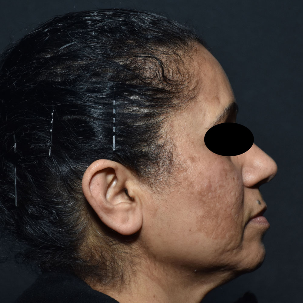 Case--2127 | Before Facials and Peels 3