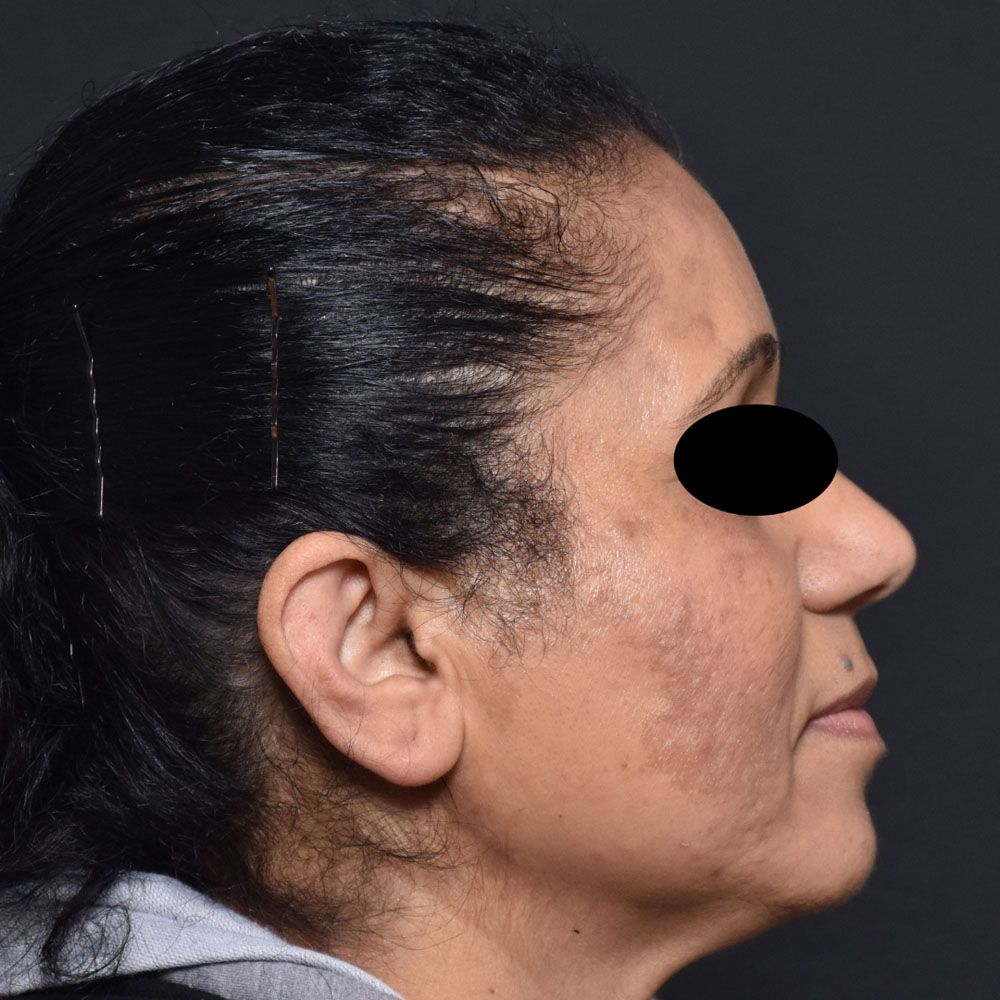 Case--2127 | After Facials and Peels 3