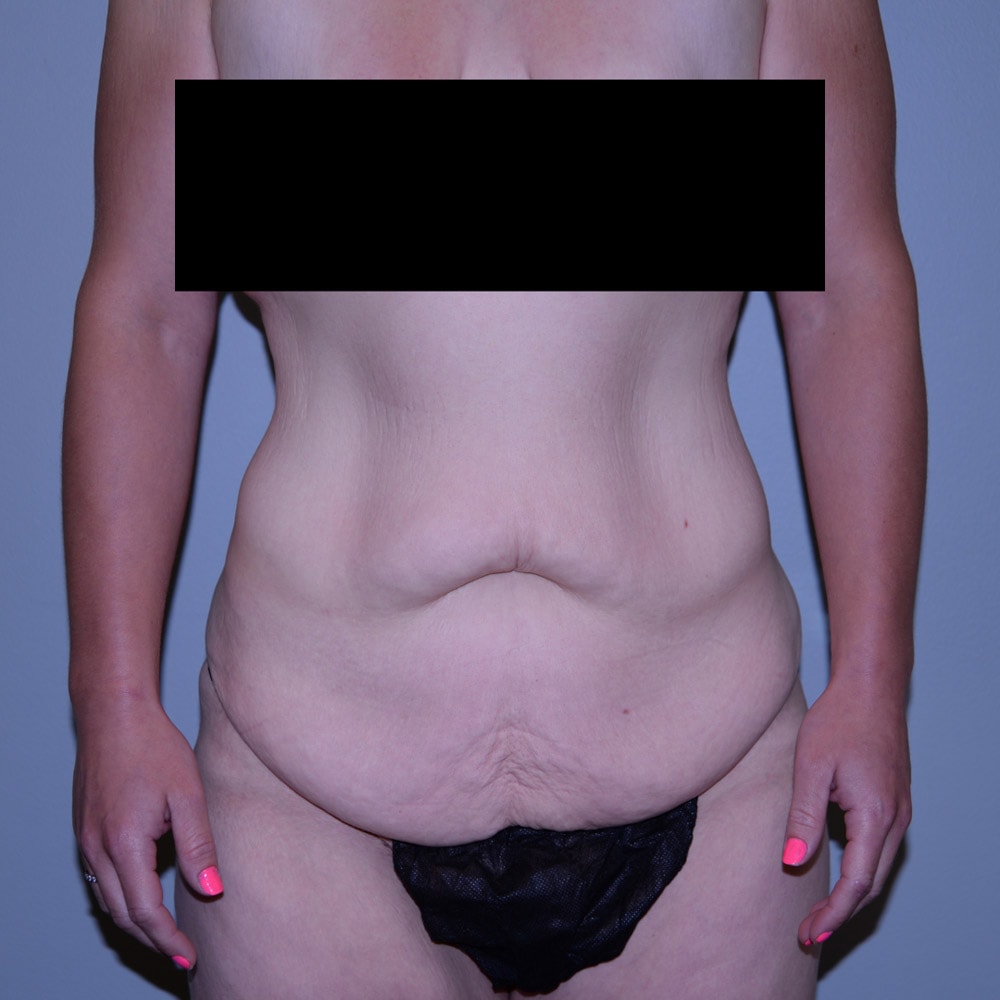 5386 Massive Weight Loss Front View Before - Lake Oswego & Portland, OR