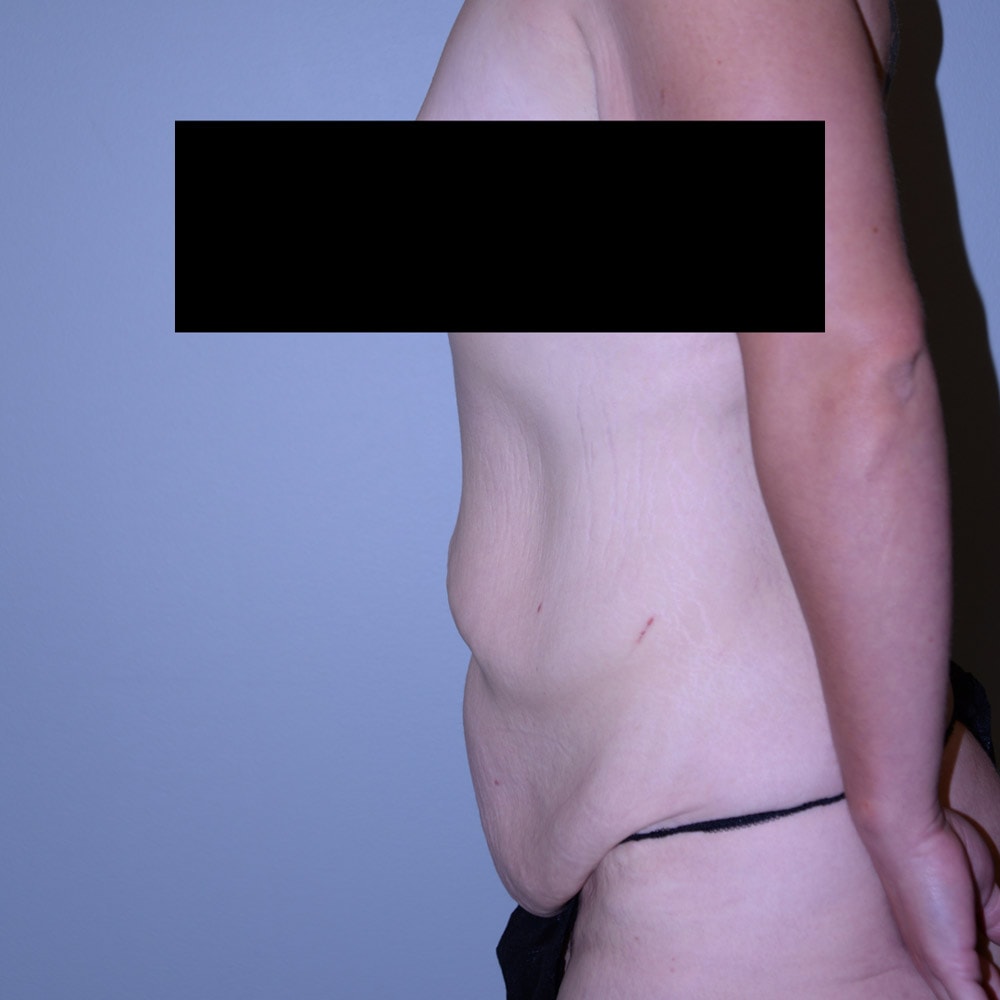 5386 Massive Weight Loss Profile View Before - Lake Oswego & Portland, OR