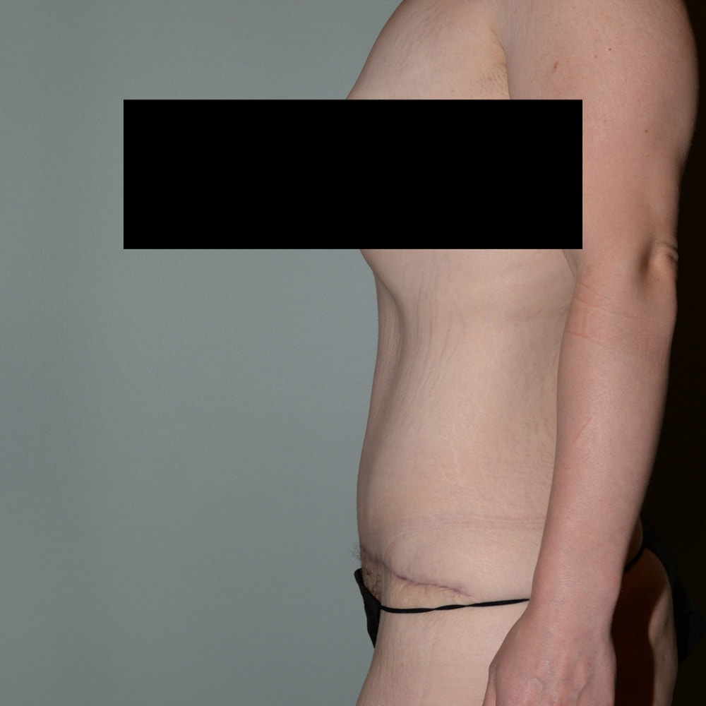 5386 Massive Weight Loss Profile View After - Lake Oswego & Portland, OR