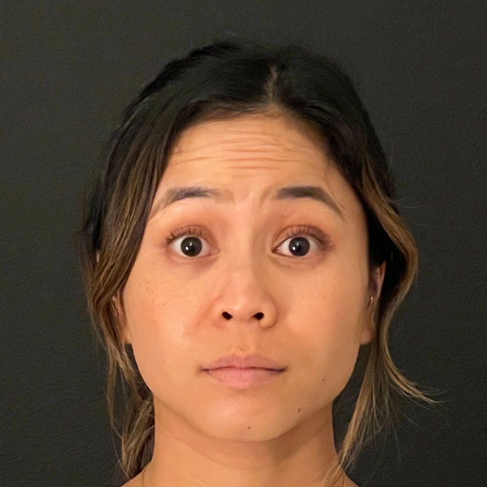 Neurotoxins 0206 Before Treatment - Lake Oswego and Portland, Oregon