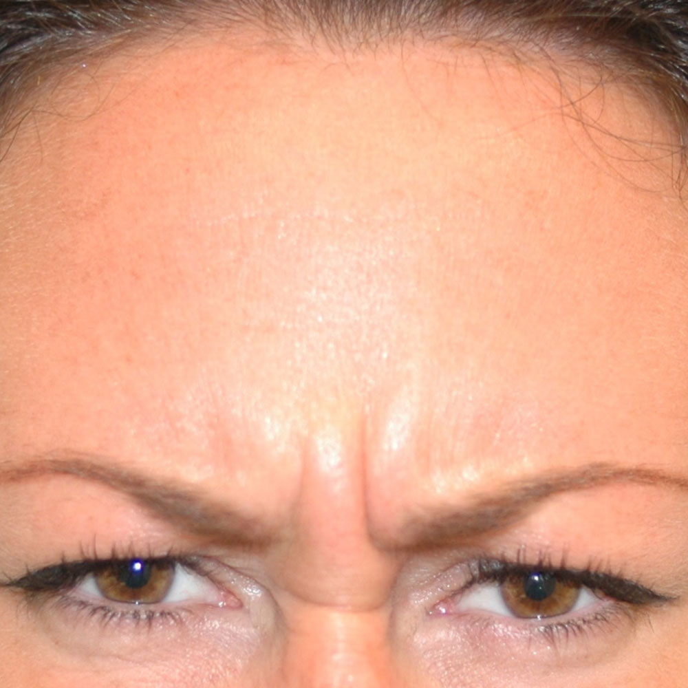 Neurotoxins 2915, Frowning, Before Treatment - Lake Oswego and Portland, Oregon