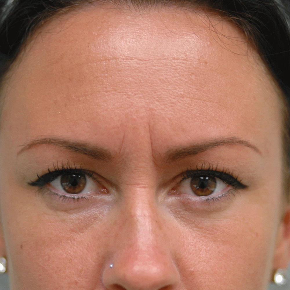 Neurotoxins 2915 Before Treatment - Lake Oswego and Portland, Oregon