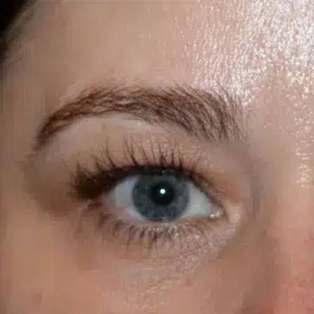 Case--2137 | Before Skin Tightening