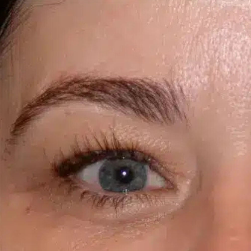 Case--2137 | After Skin Tightening