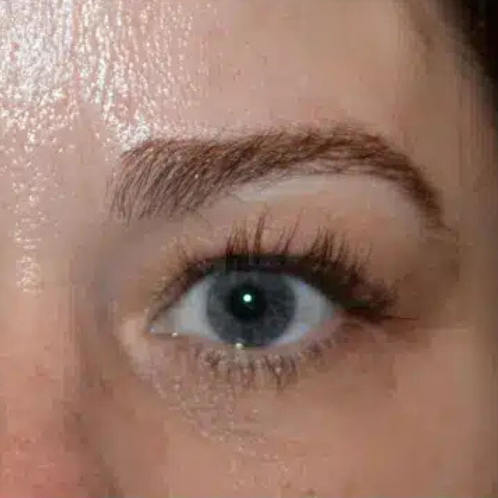 Case--2137 | Before Skin Tightening 2