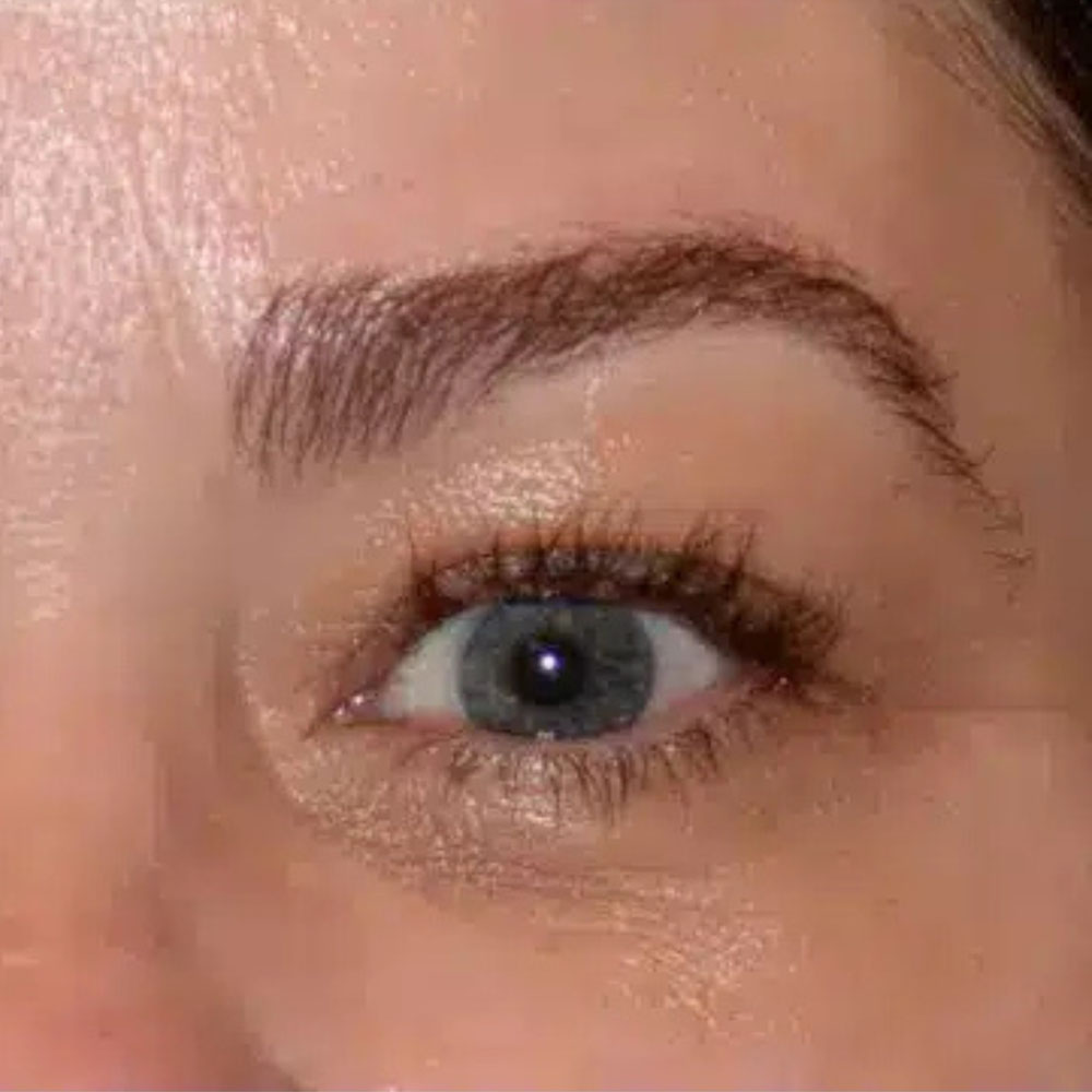 Case--2137 | After Skin Tightening 2