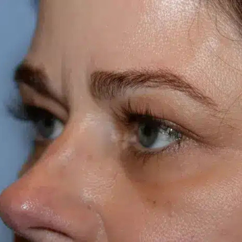 Case--2137 | Before Skin Tightening 3