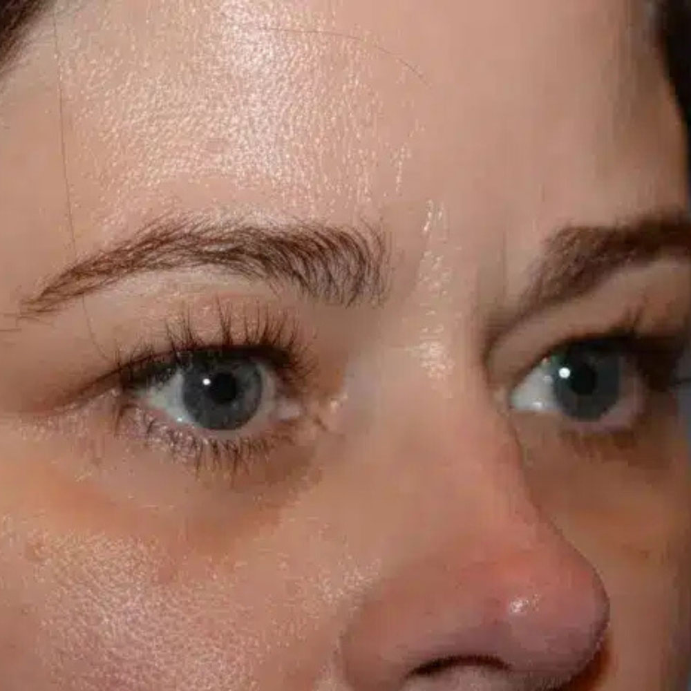 Case--2137 | Before Skin Tightening 4