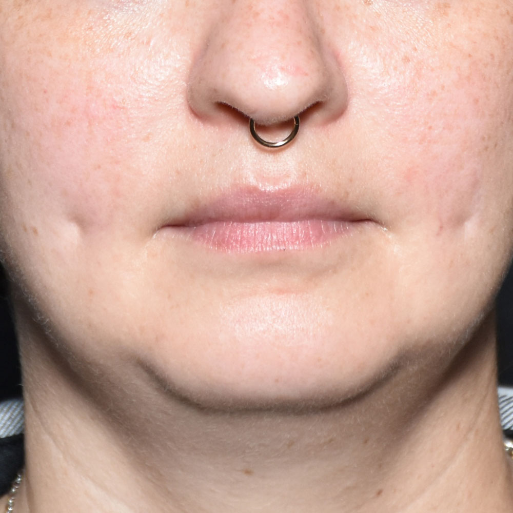 Case--2138 | Before Skin Tightening