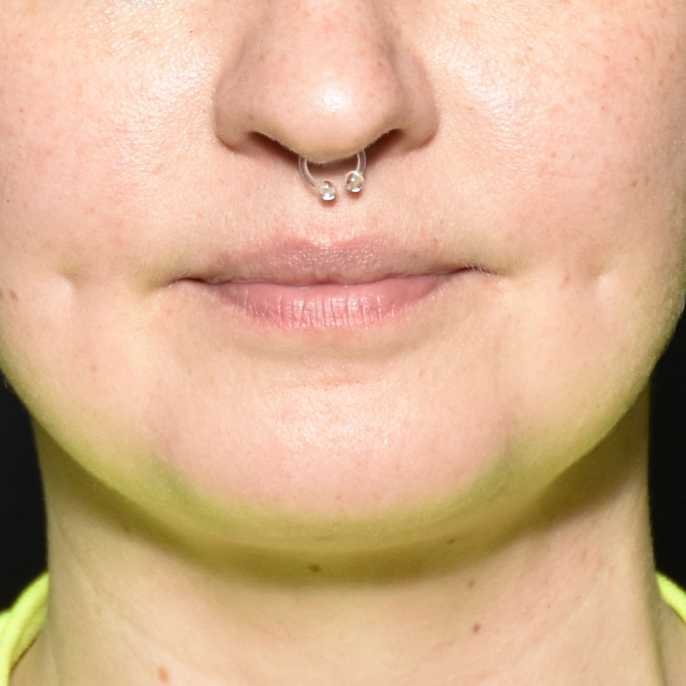 Case--2138 | After Skin Tightening