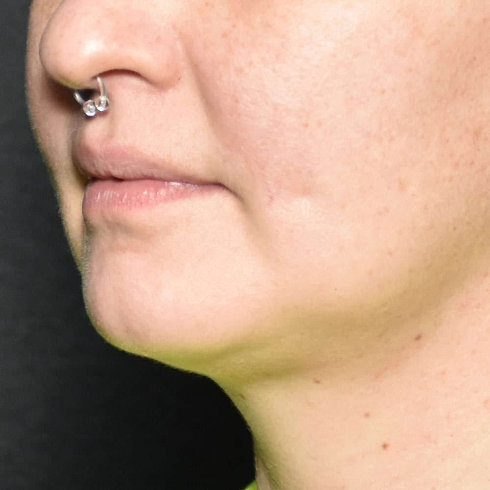 Case--2138 | After Skin Tightening 2