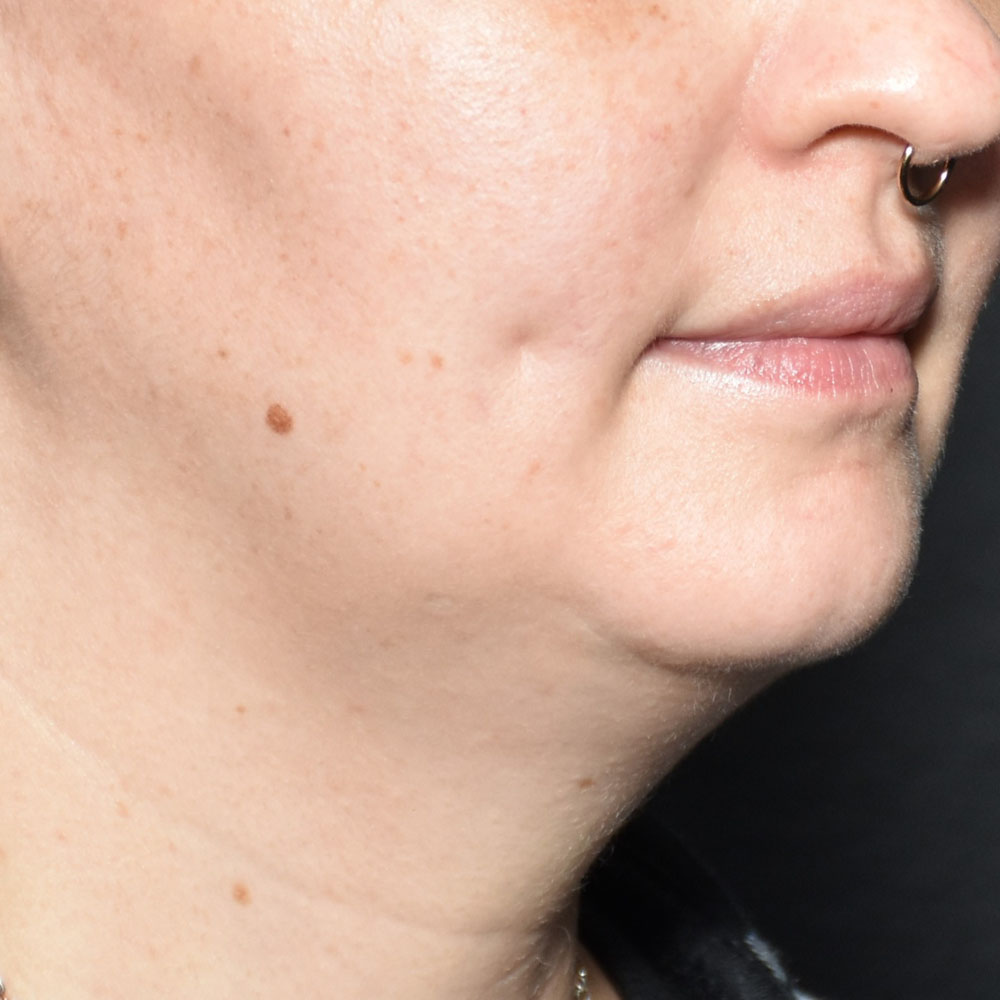 Case--2138 | Before Skin Tightening 3