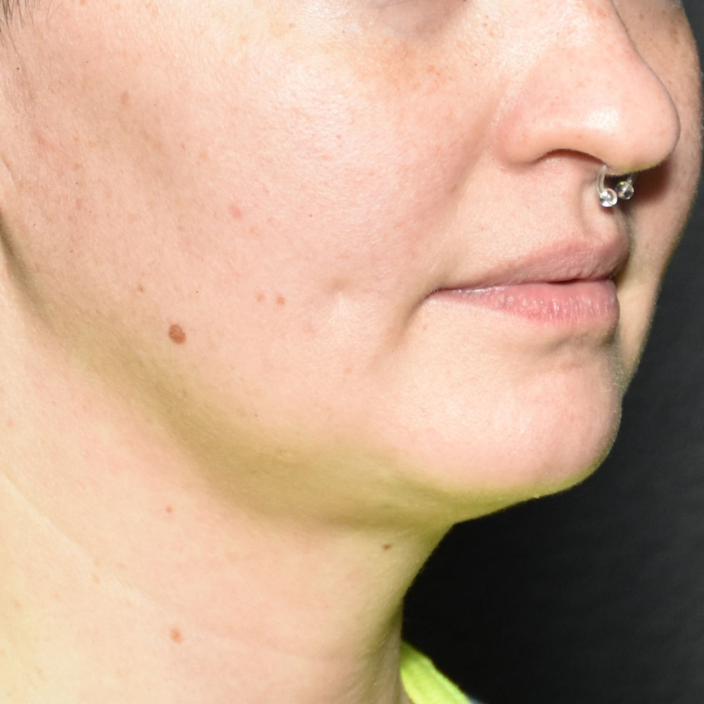 Case--2138 | After Skin Tightening 3