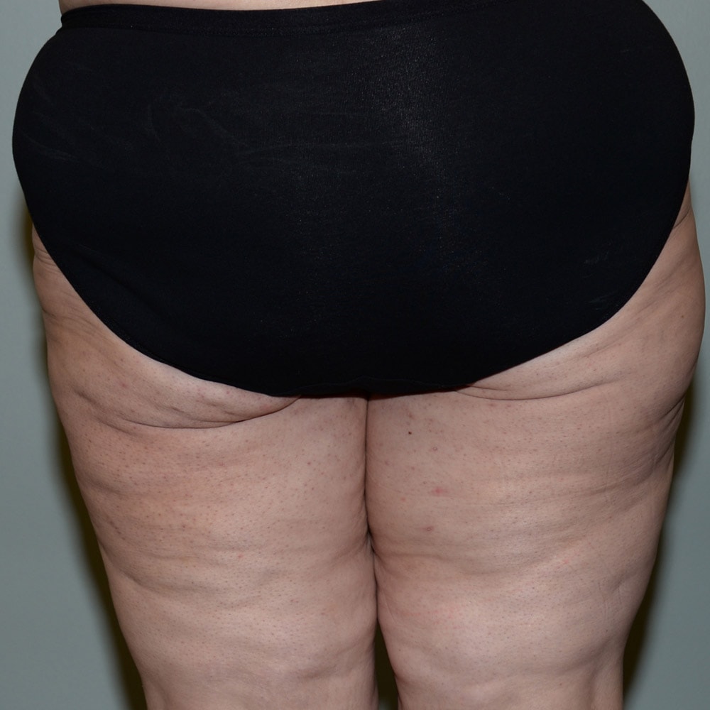 Case 6667 Before Thigh Lift Surgery in Lake Oswego & Portland, OR
