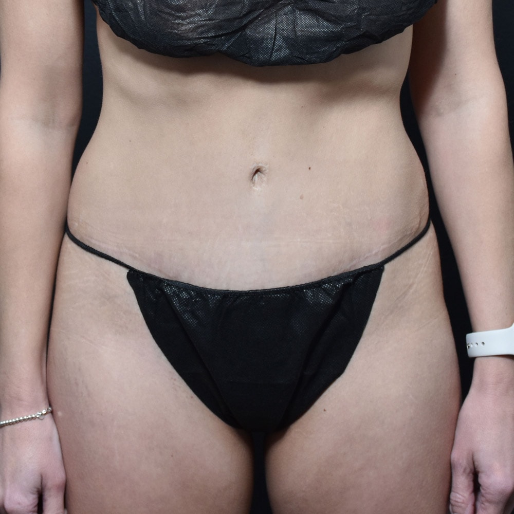 Case 10189 Front View, After Tummy Tuck in Lake Oswego & Portland, OR