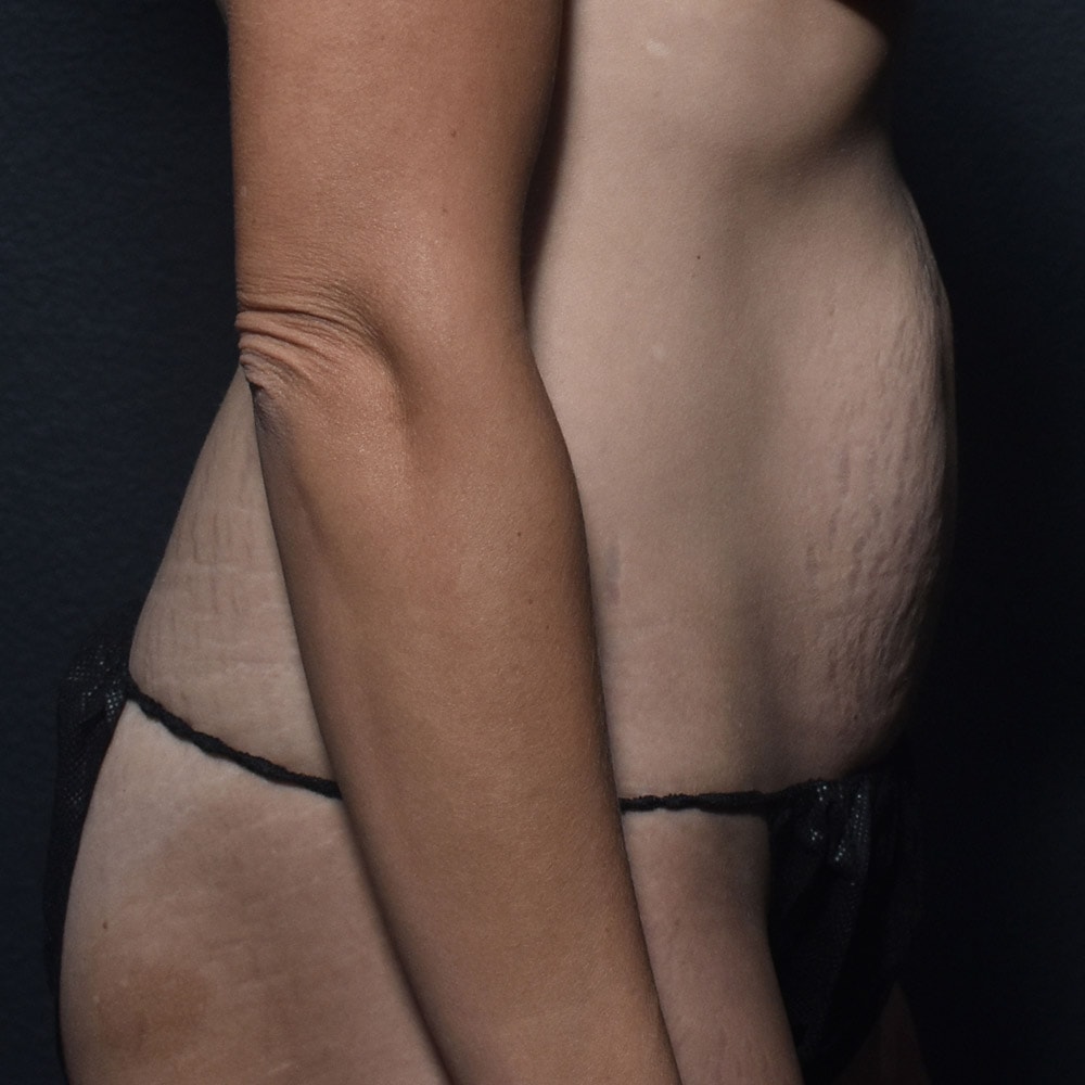 Case 10189 Right View, Before Tummy Tuck in Lake Oswego & Portland, OR