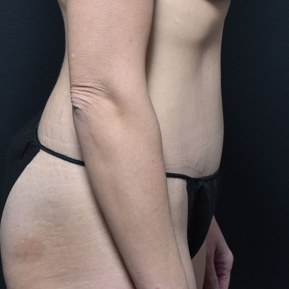 Case 10189 Right View, After Tummy Tuck in Lake Oswego & Portland, OR