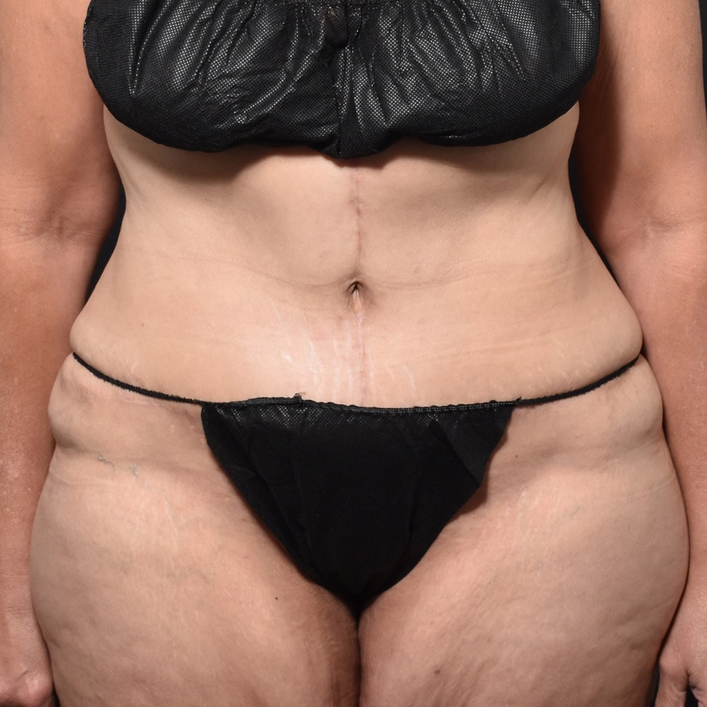 Case 10611 Front View, After Tummy Tuck in Lake Oswego & Portland, OR