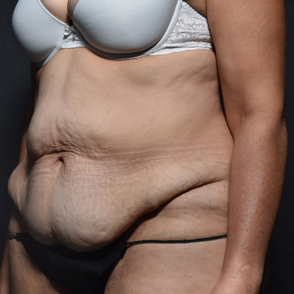 Case 10611 Oblique View, Before Tummy Tuck in Lake Oswego & Portland, OR