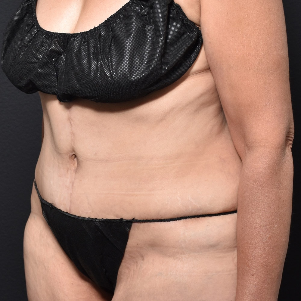 Case 10611 Oblique View, After Tummy Tuck in Lake Oswego & Portland, OR