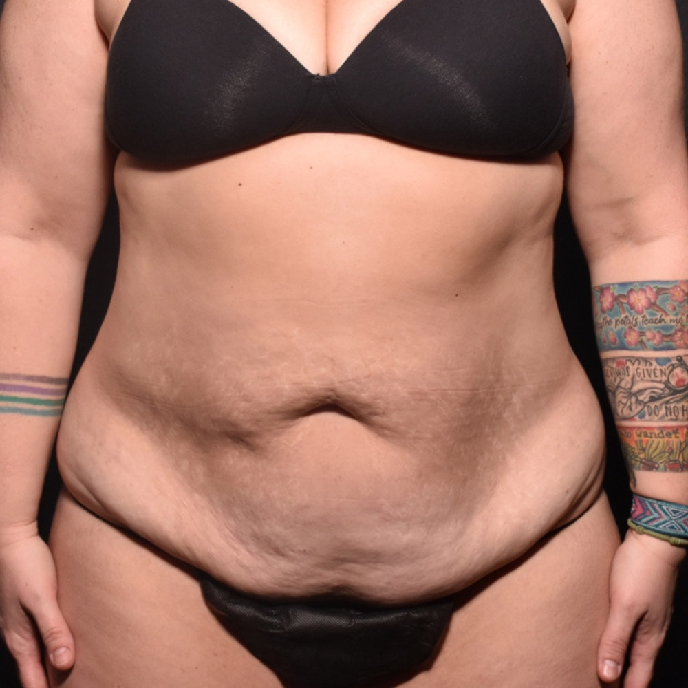 Case 10905 Front View, Before Tummy Tuck in Lake Oswego & Portland, OR
