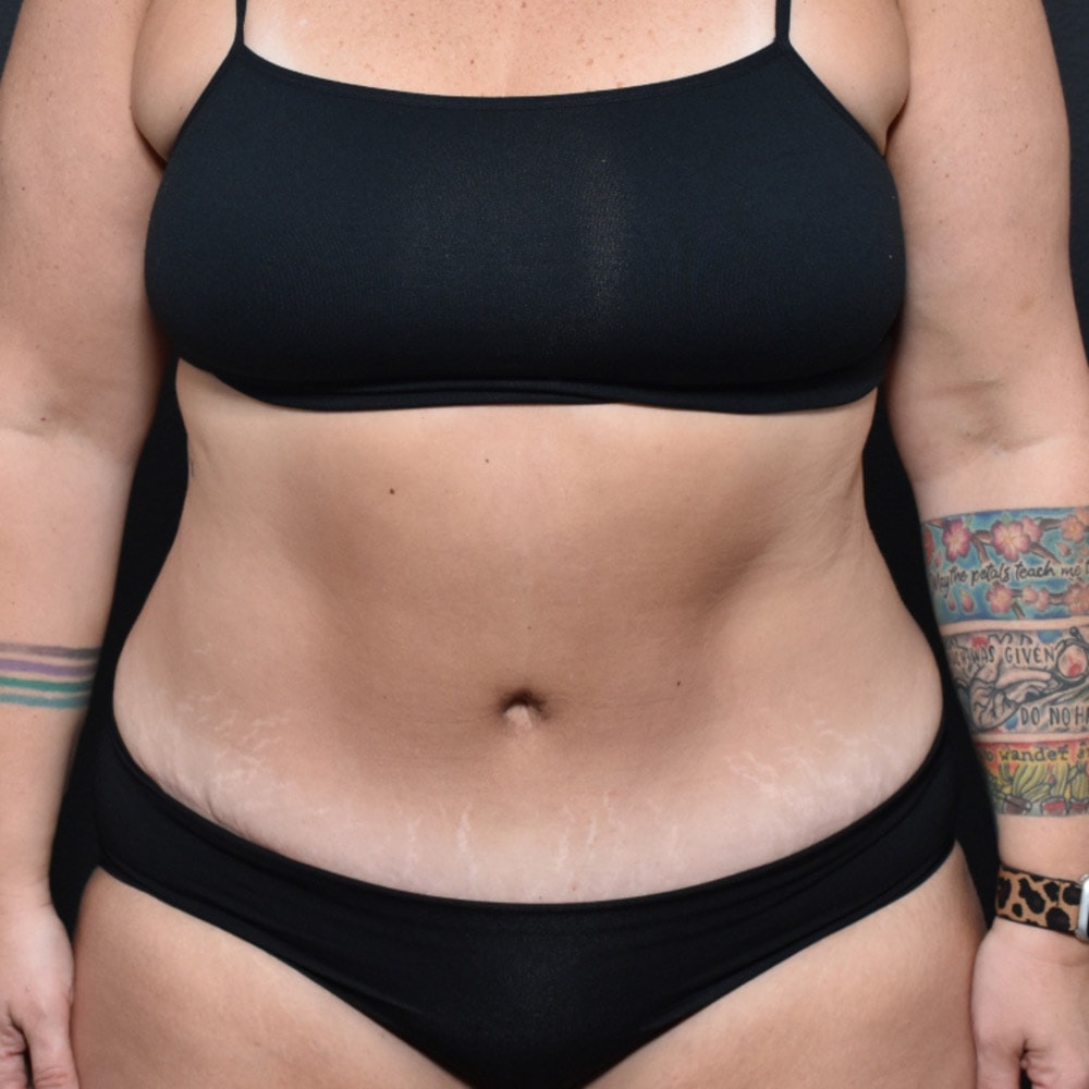 Case 10905 Front View, After Tummy Tuck in Lake Oswego & Portland, OR