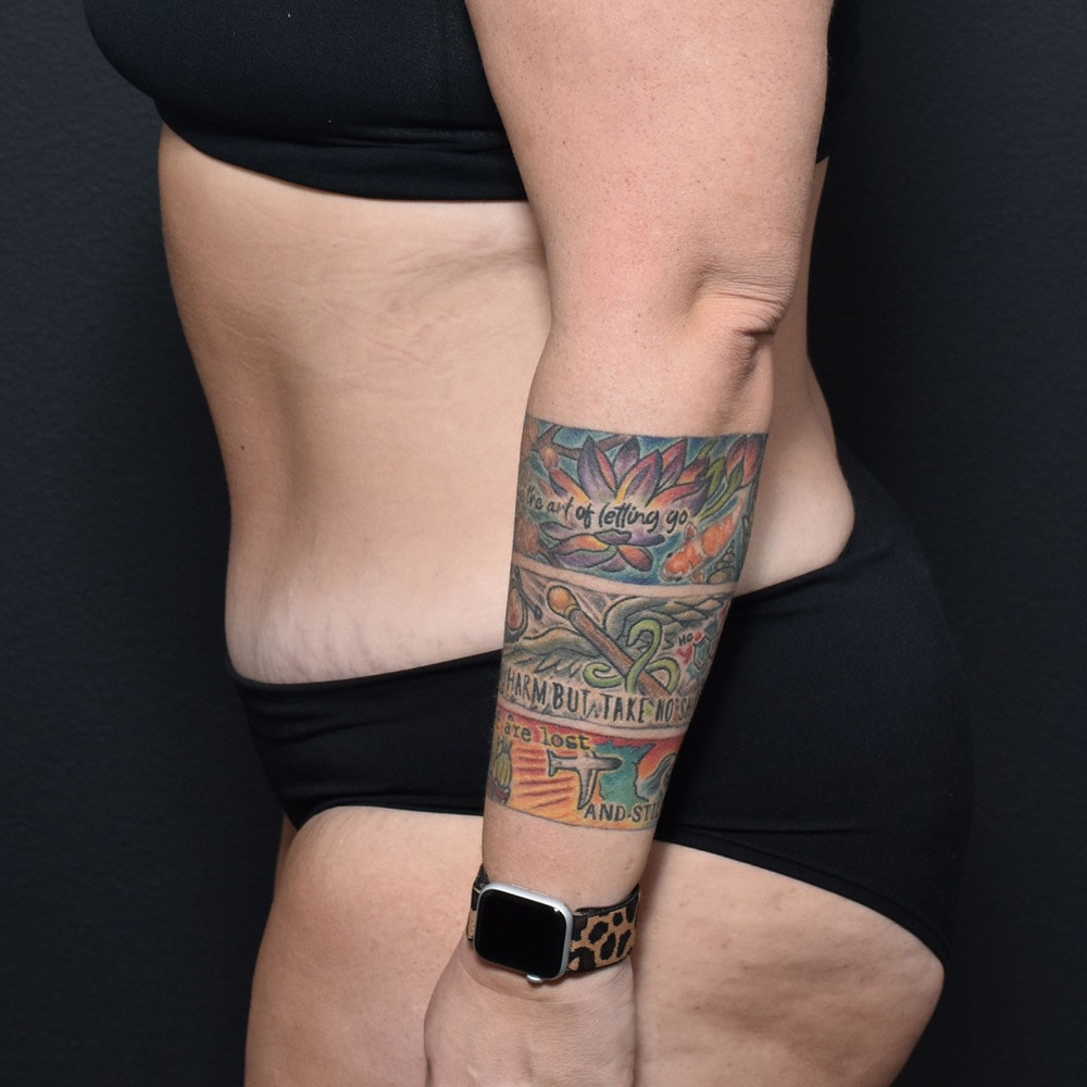 Case 10905 Left View, After Tummy Tuck in Lake Oswego & Portland, OR