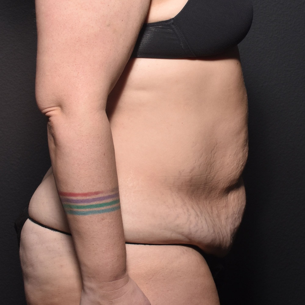 Case 10905 Right View, Before Tummy Tuck in Lake Oswego & Portland, OR