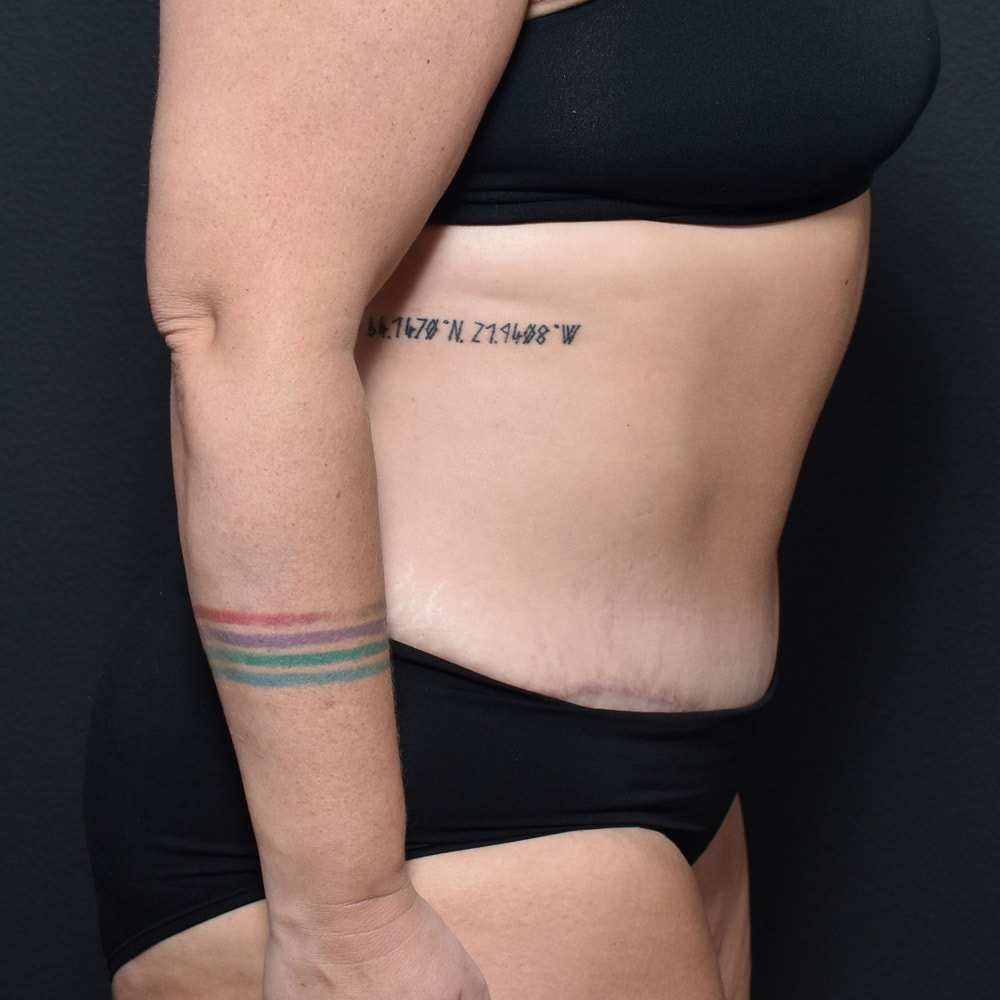 Case--10905 | After Tummy Tuck 3