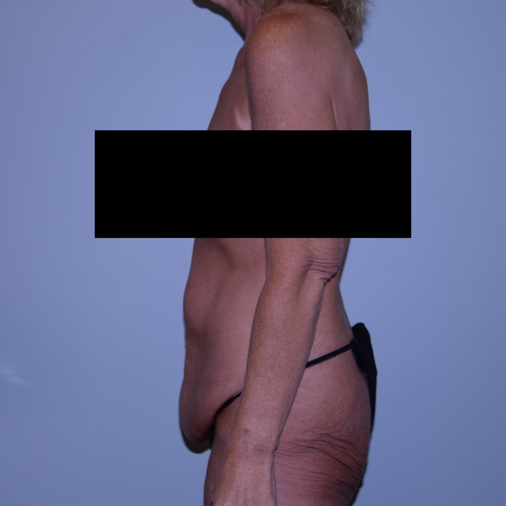 Case 5404 Left View, Before Tummy Tuck in Lake Oswego & Portland, OR
