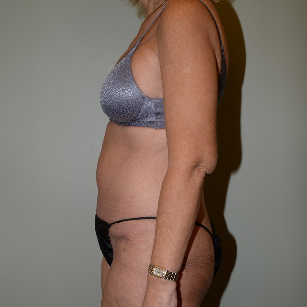 Case 5404 Left View, After Tummy Tuck in Lake Oswego & Portland, OR