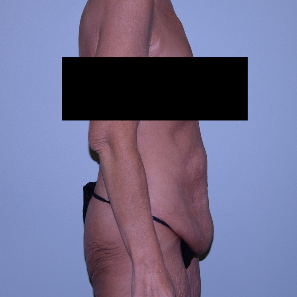 Case--5404 | Before Tummy Tuck 3