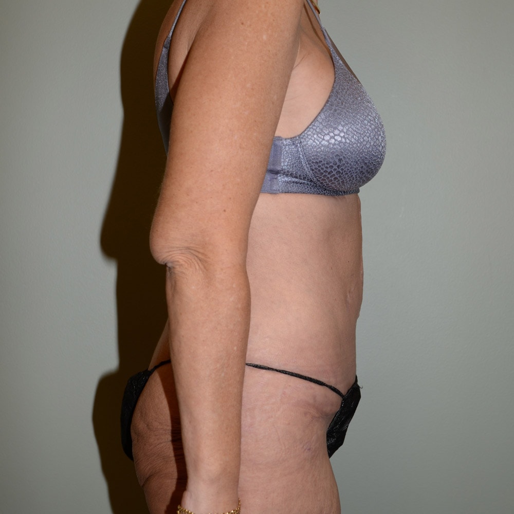 Case 5404 Right View, After Tummy Tuck in Lake Oswego & Portland, OR