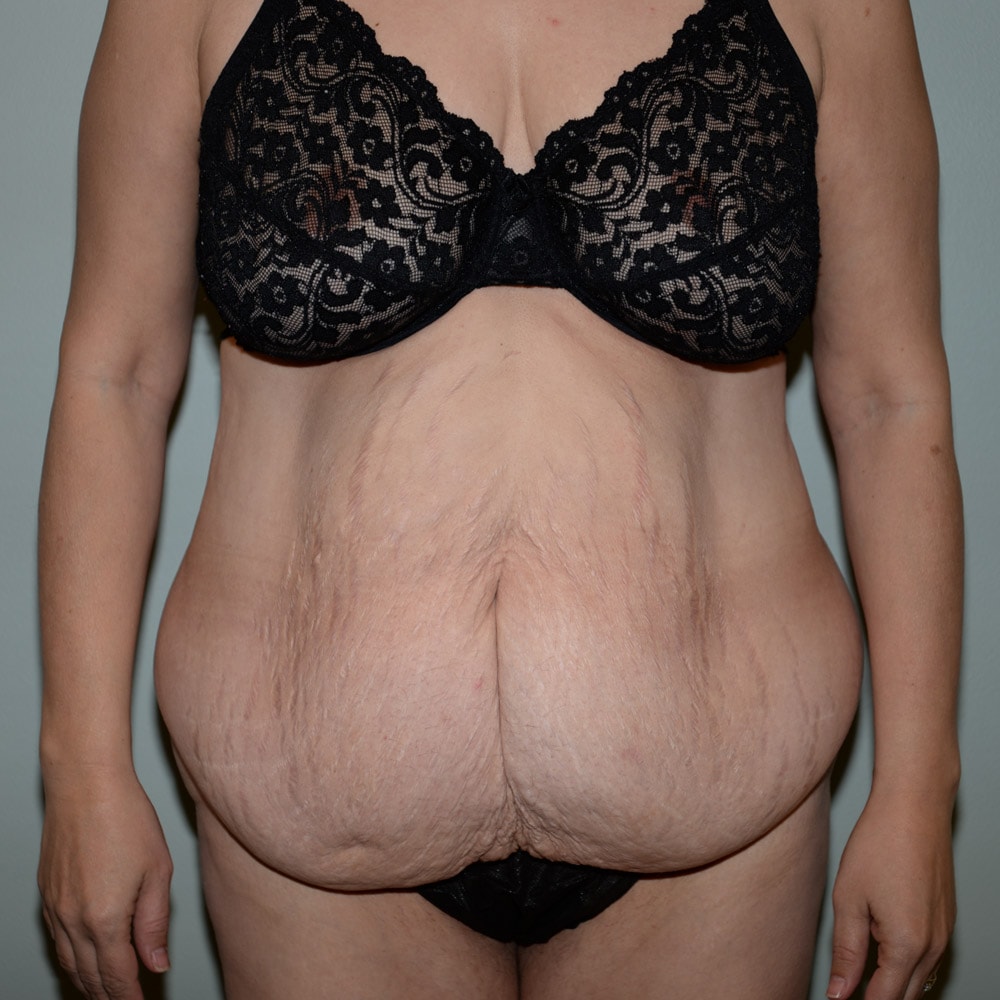 Case 5724 Front View, Before Tummy Tuck in Lake Oswego & Portland, OR