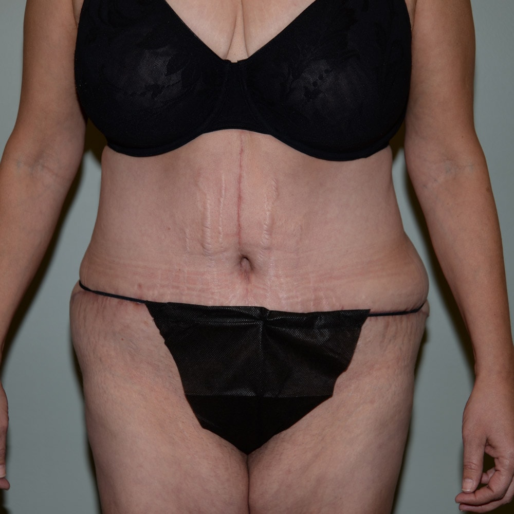 Case 5724 Front View, After Tummy Tuck in Lake Oswego & Portland, OR