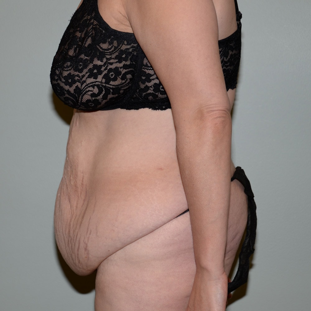 Case 5724 Left View, Before Tummy Tuck in Lake Oswego & Portland, OR