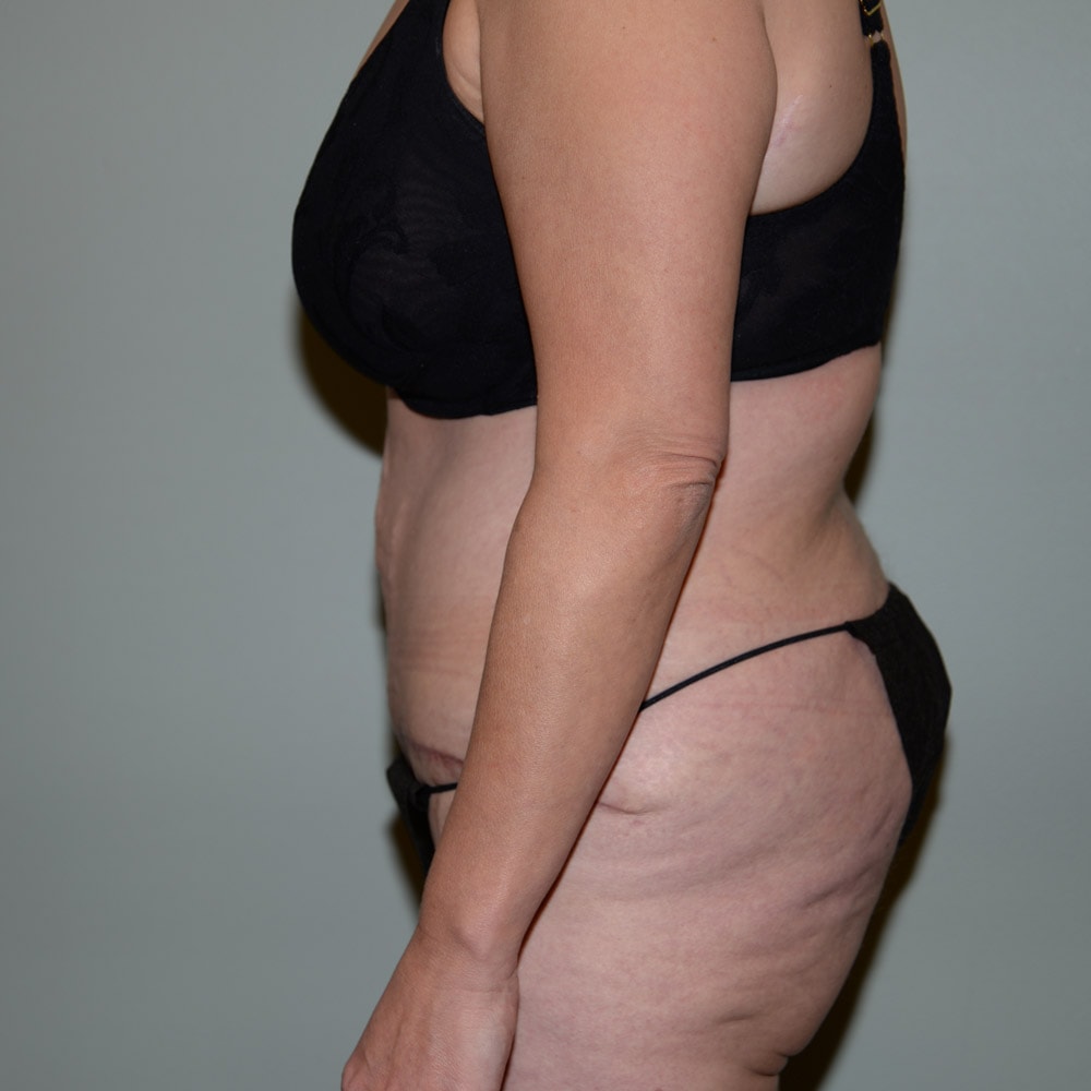 Case 5724 Left View, After Tummy Tuck in Lake Oswego & Portland, OR