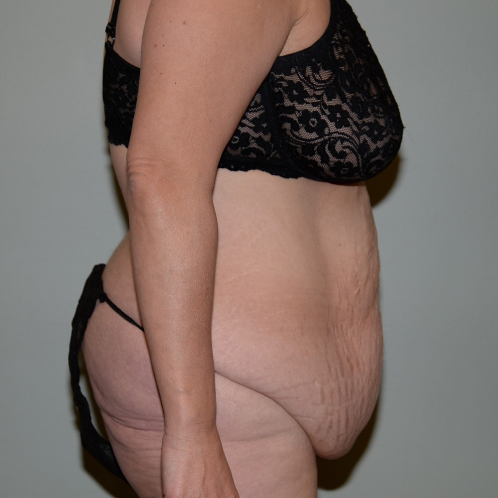 Case 5724 Right View, Before Tummy Tuck in Lake Oswego & Portland, OR