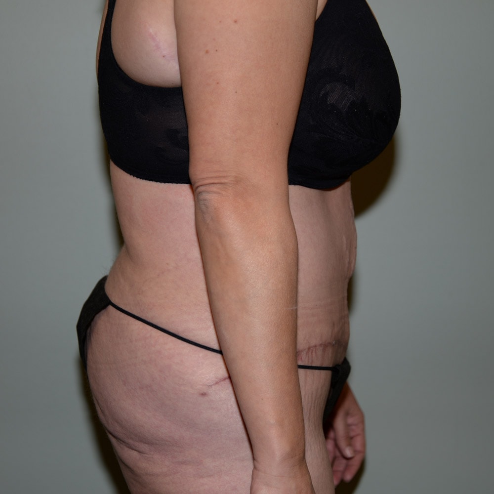 Case--5724 | After Tummy Tuck 3