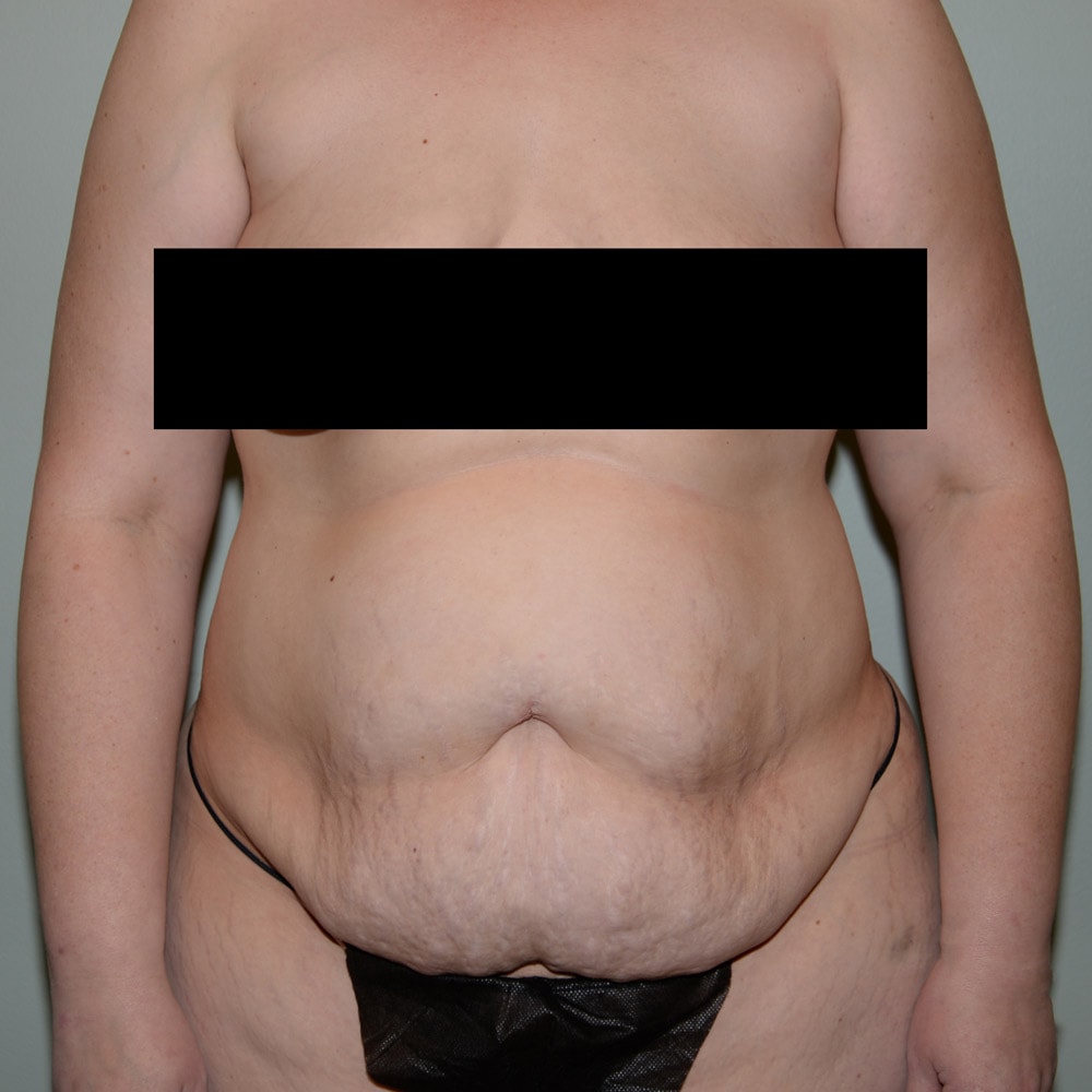 Case 5738 Front View, Before Tummy Tuck in Lake Oswego & Portland, OR